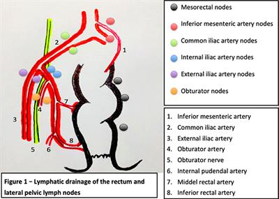 Controversies in the Management of Lateral Pelvic Lymph Nodes in Patients With Advanced Rectal Cancer: East or West?